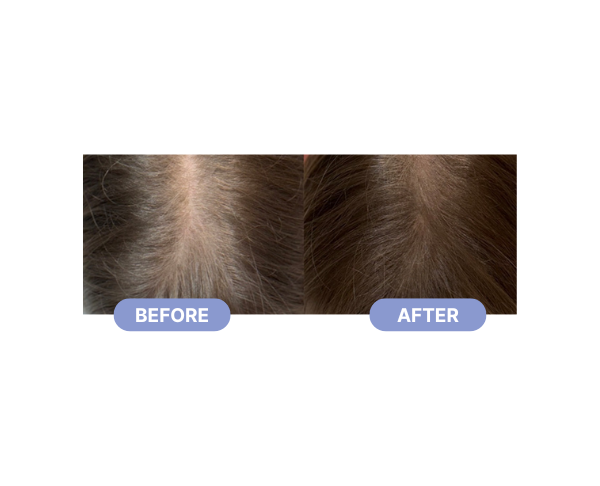 PRP Hair Treatment Before After