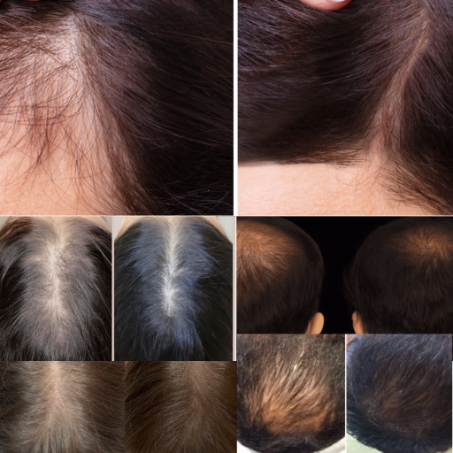 PRP Hair Treatment