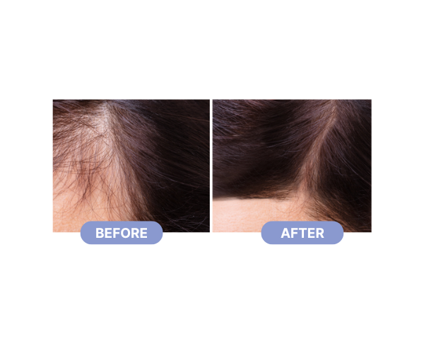 PRP Treatment Before After