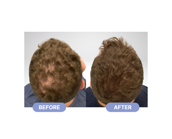 before after exosome hair treatment