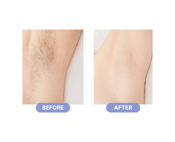 laser hair removal before after
