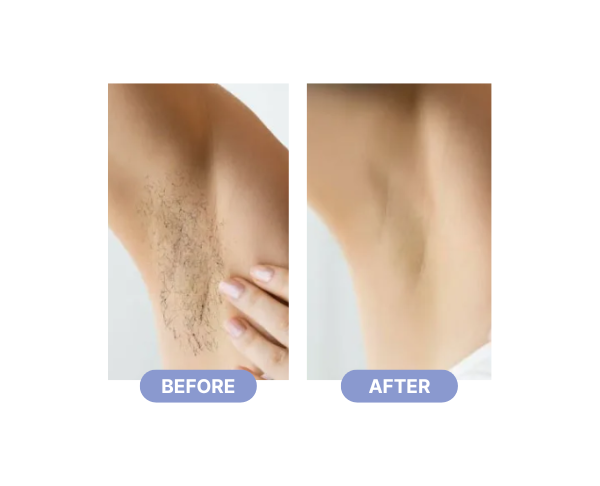 laser hair removal before and after