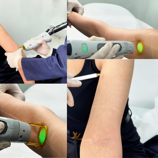 laser hair removal cost